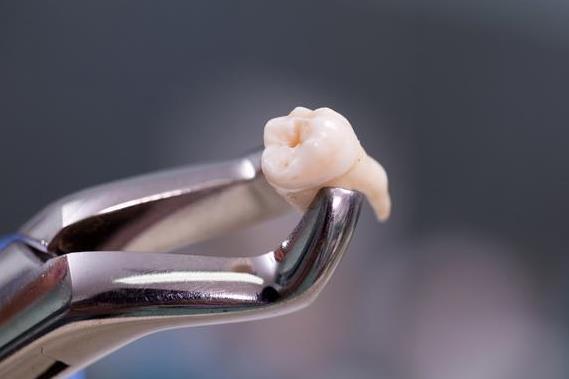 拔完智齿睡觉张嘴还是闭嘴？拔出智齿疼痛后，通常会疼几天