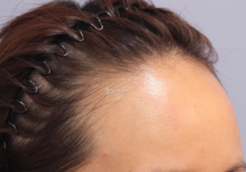 发际线高会秃顶吗 发际线高的人有什么烦恼