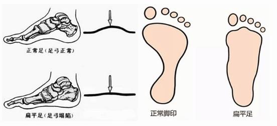 扁平足能跑步吗？扁平足跑步有什么危害？如何矫正