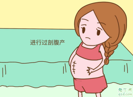 剖宫产横剖竖剖哪个好 第二次剖腹产是在原伤口上剖吗