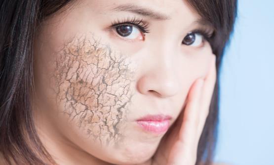 冬季皮肤干燥是怎么回事 皮肤干燥要怎么缓解推荐5大妙招