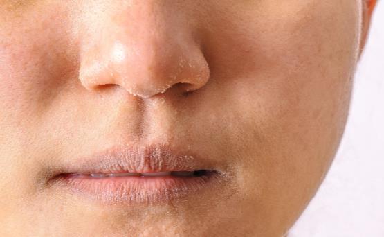 冬季皮肤干燥是怎么回事 皮肤干燥要怎么缓解推荐5大妙招