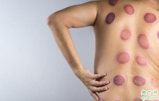 经常拔火罐能祛湿吗 拔罐时哪些事项要注意