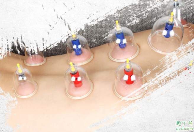 经期能不能拔火罐 拔火罐有哪些禁忌