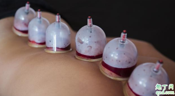 便秘拔罐有用吗 得了便秘的人能不能拔火罐