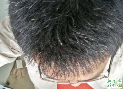 白头发多是不是肝脏不好 年轻为什么头发会白