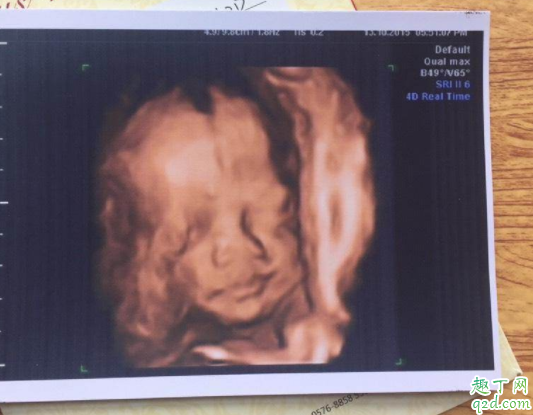孕几周做四维是最佳时期 四维彩超几分钟做完