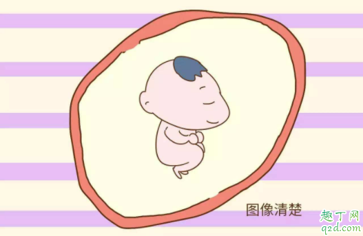 做四维能查出唐氏综合征吗 四维彩超排查哪些畸形