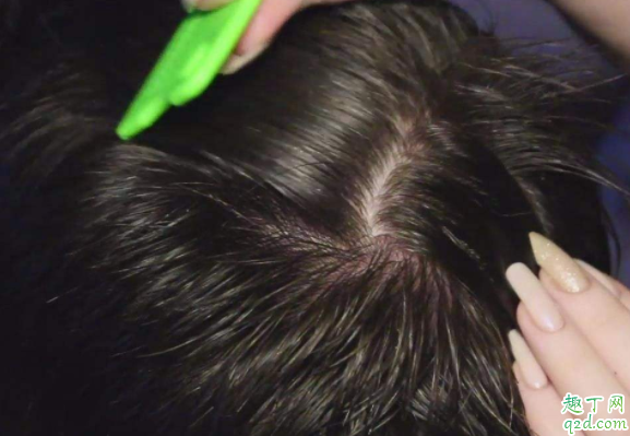 怎么知道头皮有没有螨虫 头上为什么会有螨虫呢