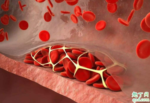 血栓自己能消除吗 有血栓的人每天运动是否好些