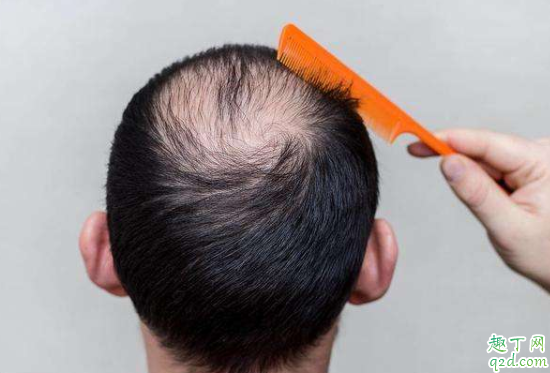 如何预防秃顶掉发 为什么男生比女生容易秃头