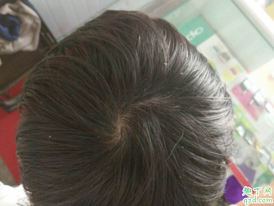 如何预防秃顶掉发 为什么男生比女生容易秃头