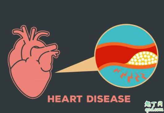 冠心病是不是遗传病 冠心病中医调养方剂