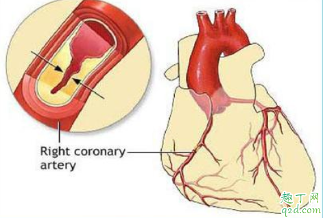 冠心病可以治疗除根吗 冠心病要做手术吗