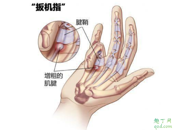 怎么确定自己是不是腱鞘炎 日常如何防治腱鞘炎