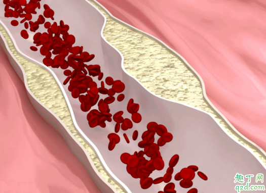 脖子血管有斑块是什么原因 动脉硬化狭窄怎么治疗