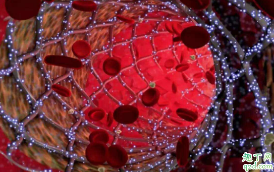 装了心脏支架还可以取出来吗 心脏支架有害处吗