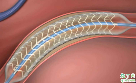 心脏支架后为什么吃药 冠心病能不能不做支架