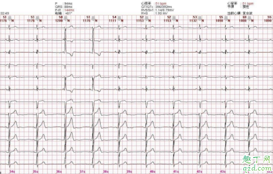 心电图正常心脏正常吗 确诊冠心病做哪些检查