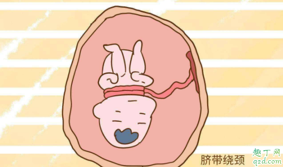 脐带绕颈顺产有危险吗 胎儿脐带绕颈要注意什么