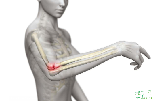 网球肘是什么症状 网球肘是不是好不了了