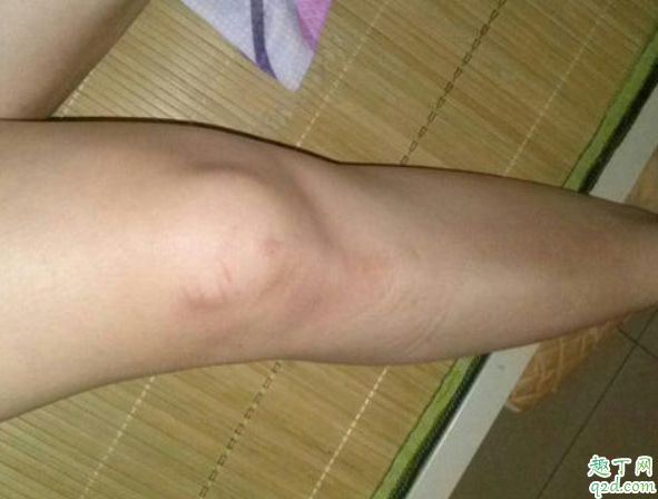 膝盖疼痛热敷能不能加快痊愈 受凉会导致膝盖疼吗