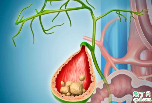 胆结石能自己化掉吗 胆结石有什么症状