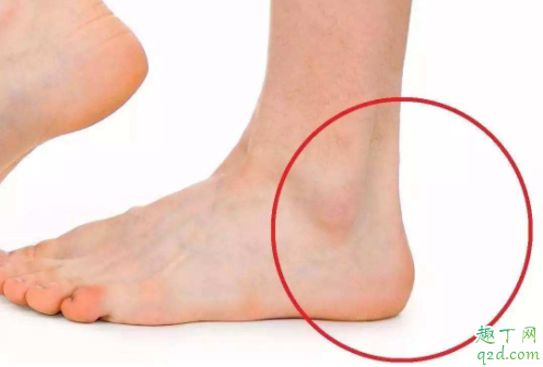 为什么痛风都是从脚开始 半夜脚疼是痛风吗