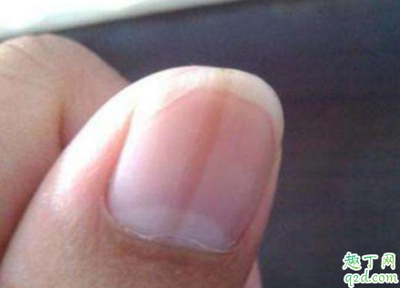 压力大会造成指甲竖纹吗 生活习惯会影响指甲竖纹吗