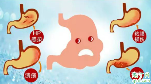 胃癌是不是必须开刀 胃癌症会不会传染