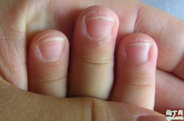 手老脱皮是咋回事 手指脱皮该怎么解决
