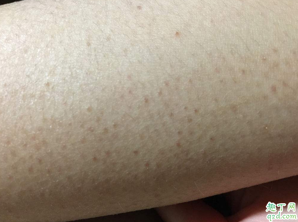 擦身体乳能不能去鸡皮 女生如何祛除身上的鸡皮