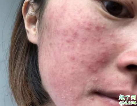 上火起痘痘可以挤破吗 上火长痘怎么快速消除