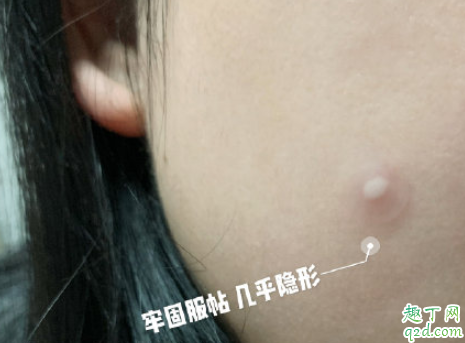oliveyoung痘痘贴怎么样 oliveyoung痘痘贴使用测评