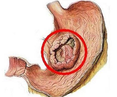 世界十大痛苦癌症排行，胃癌发病率高，肺癌死亡率最快