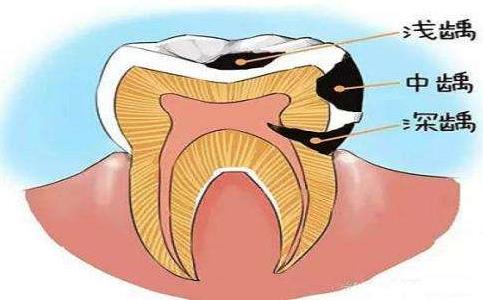 牙痛怎么办？如何预防???????龋齿牙病？饮食和卫生习惯是牙病原因