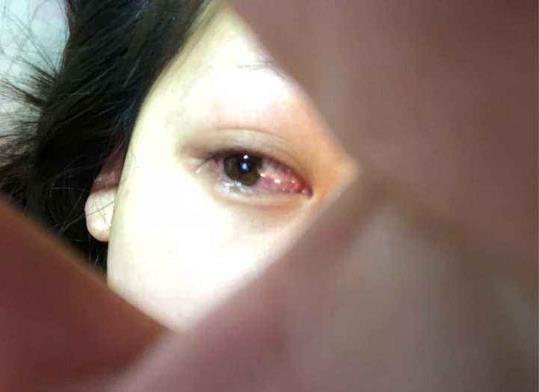 起床后上眼皮肿是怎么回事？有效缓解上眼皮肿的方法