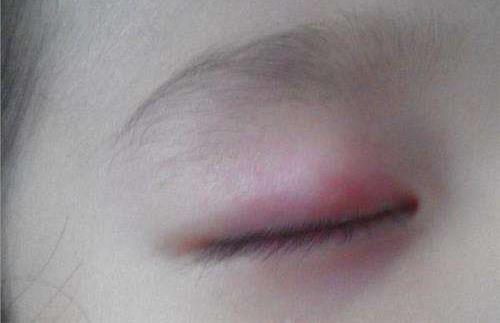 起床后上眼皮肿是怎么回事？有效缓解上眼皮肿的方法