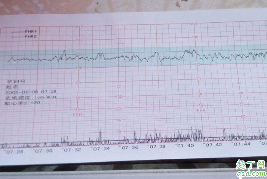 怀孕后没有看到胎心胎芽怎么回事 怀孕多长时间用胎心监护器
