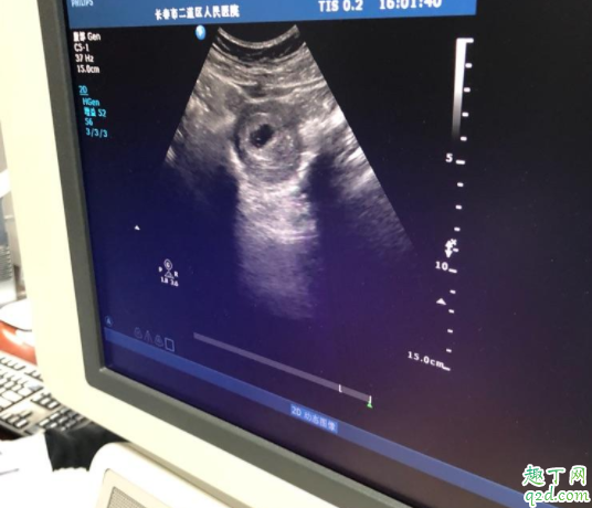 胎芽是卵黄囊发育的吗 有卵黄囊没胎芽胎心多长时间可以判定胎停