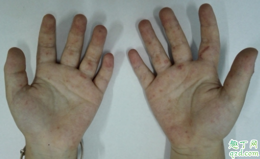 手足口疫苗打好还是不打好 接种手足口疫苗可以管多久