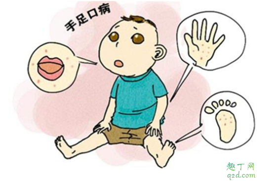 手足口疫苗打好还是不打好 接种手足口疫苗可以管多久