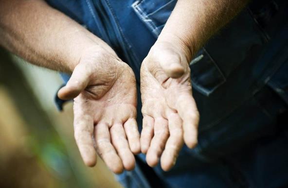 冬季是手足皲裂症多发季节 冬季如何预防脚后跟皲裂？
