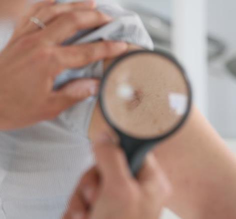 夏季皮炎的原因及症状 夏季皮炎怎么办