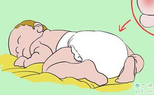 宝宝特别容易得尿布疹怎么办 宝宝为什么会有尿布疹