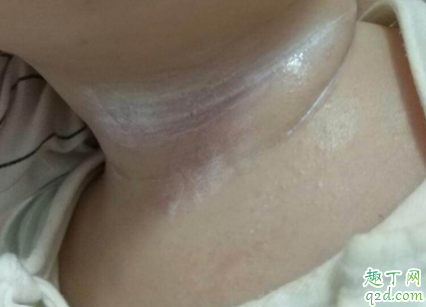 宝宝淹脖子怎么回事 宝宝淹脖子该怎么做