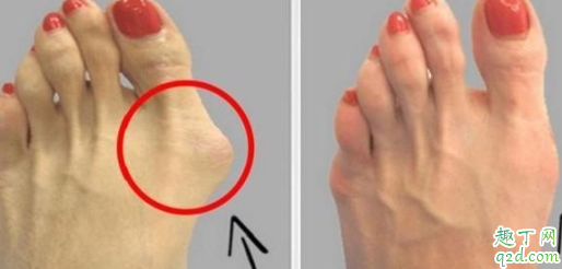 穿高跟鞋会拇外翻吗 拇外翻手术恢复后可以穿高跟鞋吗