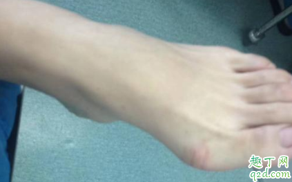 拇外翻矫正器有效果吗 拇外翻矫正器一天带多长时间