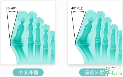拇外翻矫正器有效果吗 拇外翻矫正器一天带多长时间