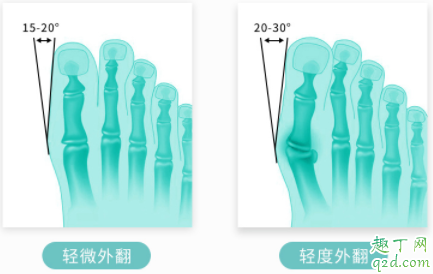 拇外翻矫正器有效果吗 拇外翻矫正器一天带多长时间